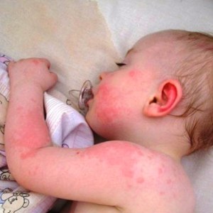 Лечение аллергии на сахар