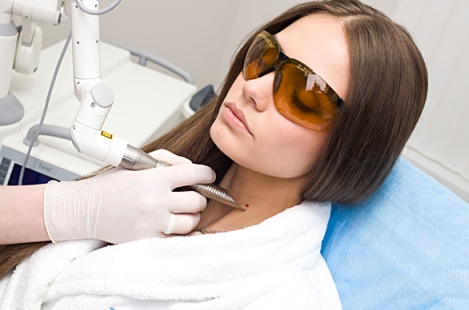 удаление бородавок лазером