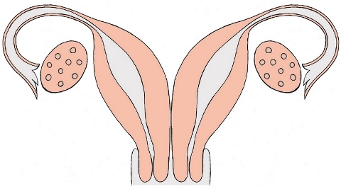 двурогая матка