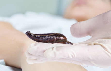 значение гирудотерапии лечение пиявками
