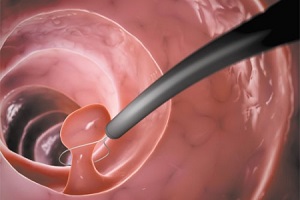 что такое гистероскопия