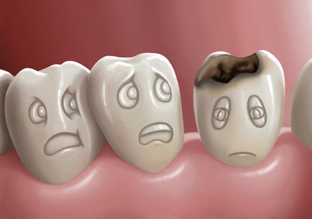 что такое кариес кариес зубов