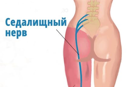 седалищный нерв