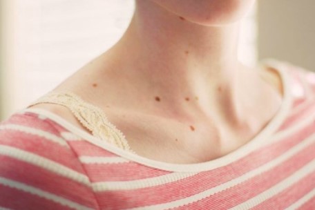 что такое родинки родинки на теле