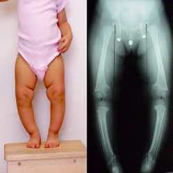 рахит Симптомы рахита