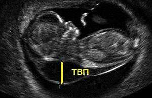 толщина воротникового пространства плода ТВП плода