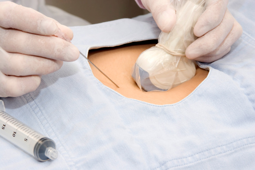 биопсия хориона при повышении ТВП процедура биопсии хориона