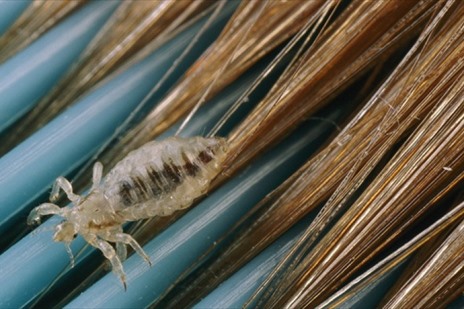 педикулез при беременности лечение вшей